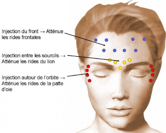 docteur chambon injection botox Lille